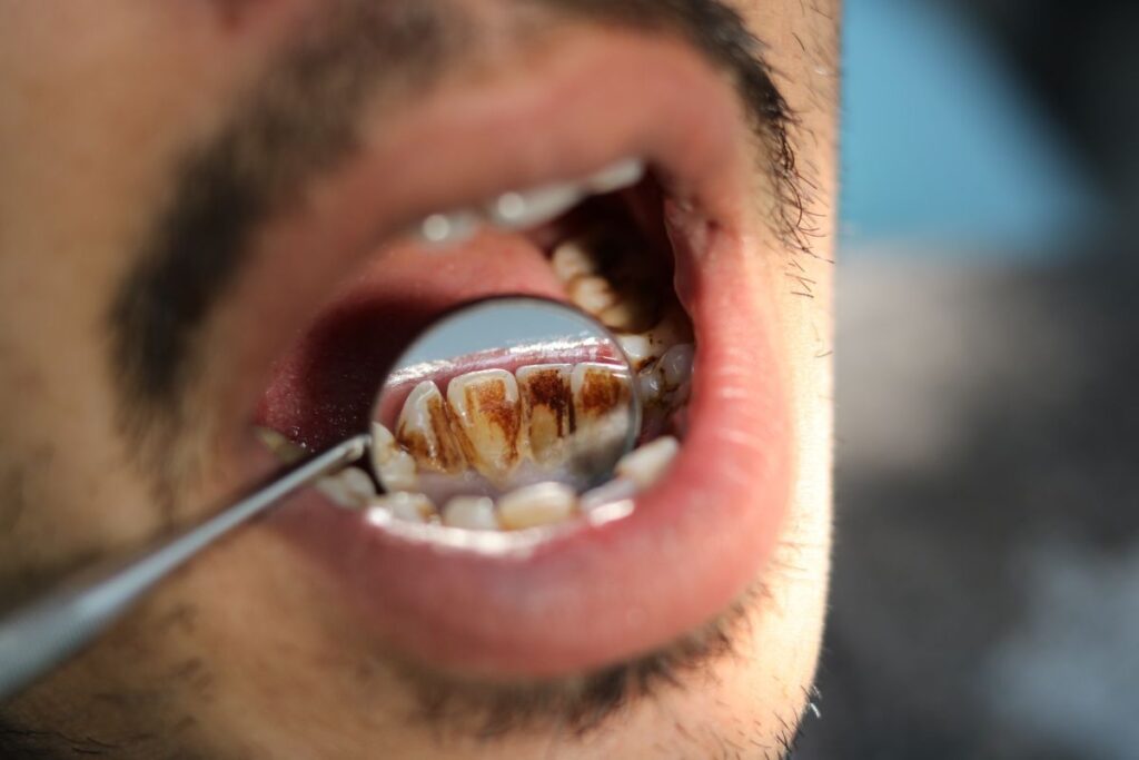 Smoking Stains on Teeth - causes