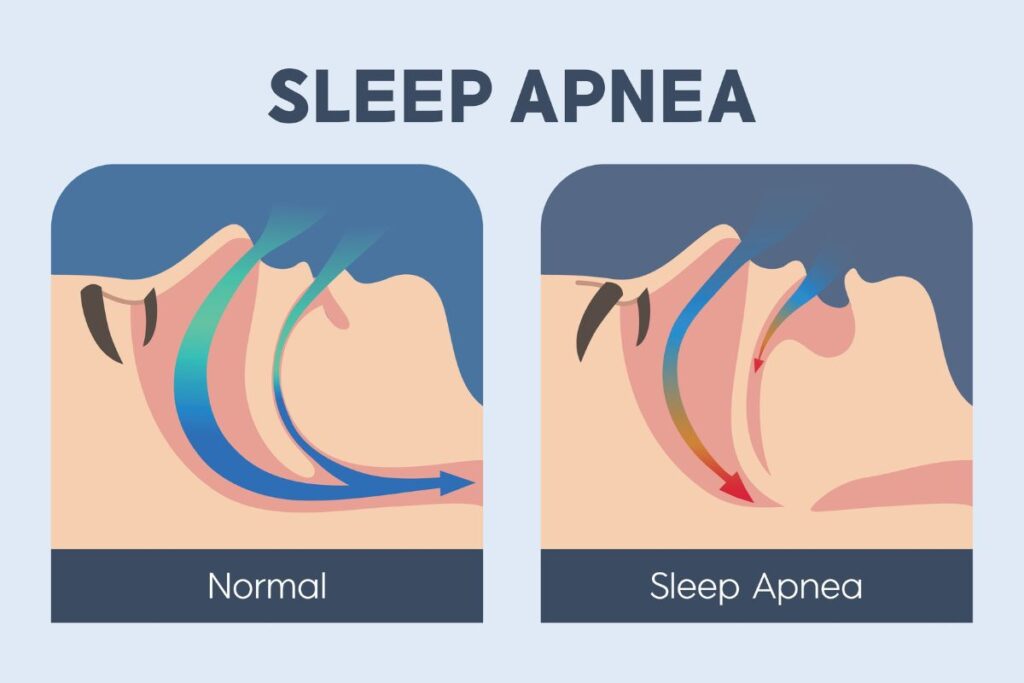 sleep apnea treatment - what is sleep apnea?