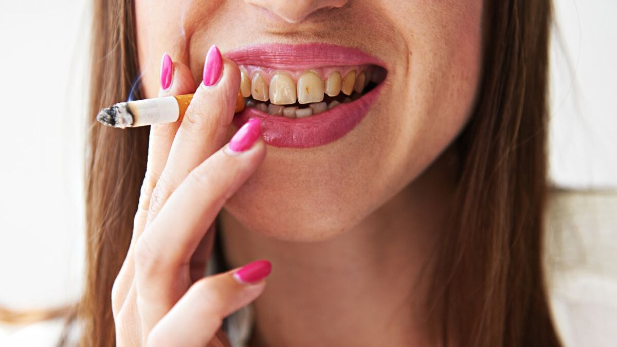How to Deal with Smoking Stains on Teeth?