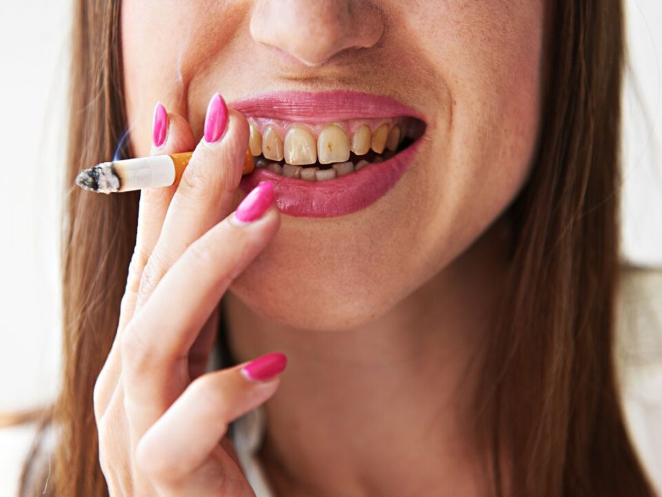 How to Deal with Smoking Stains on Teeth?