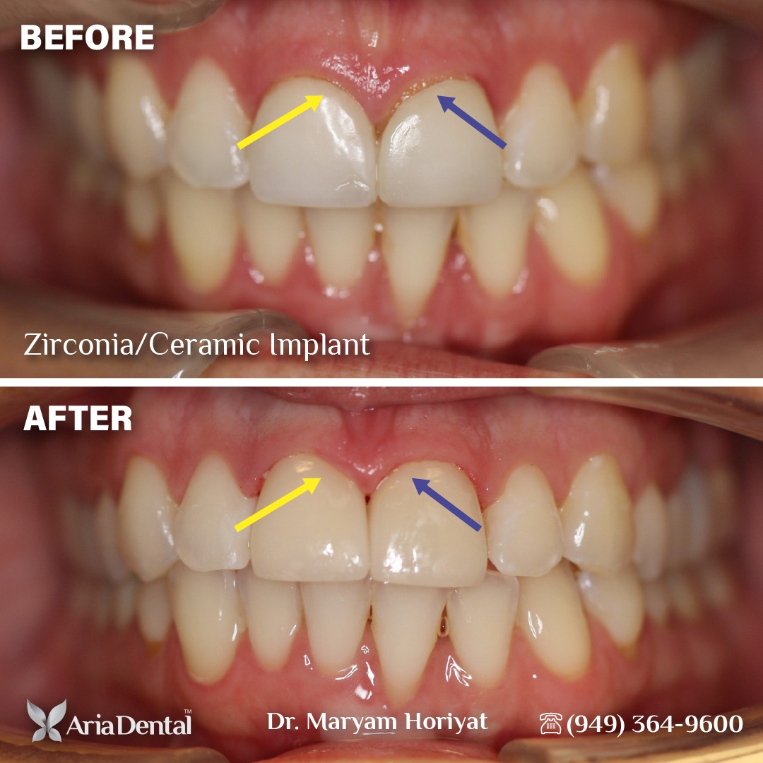 before and after aria dental