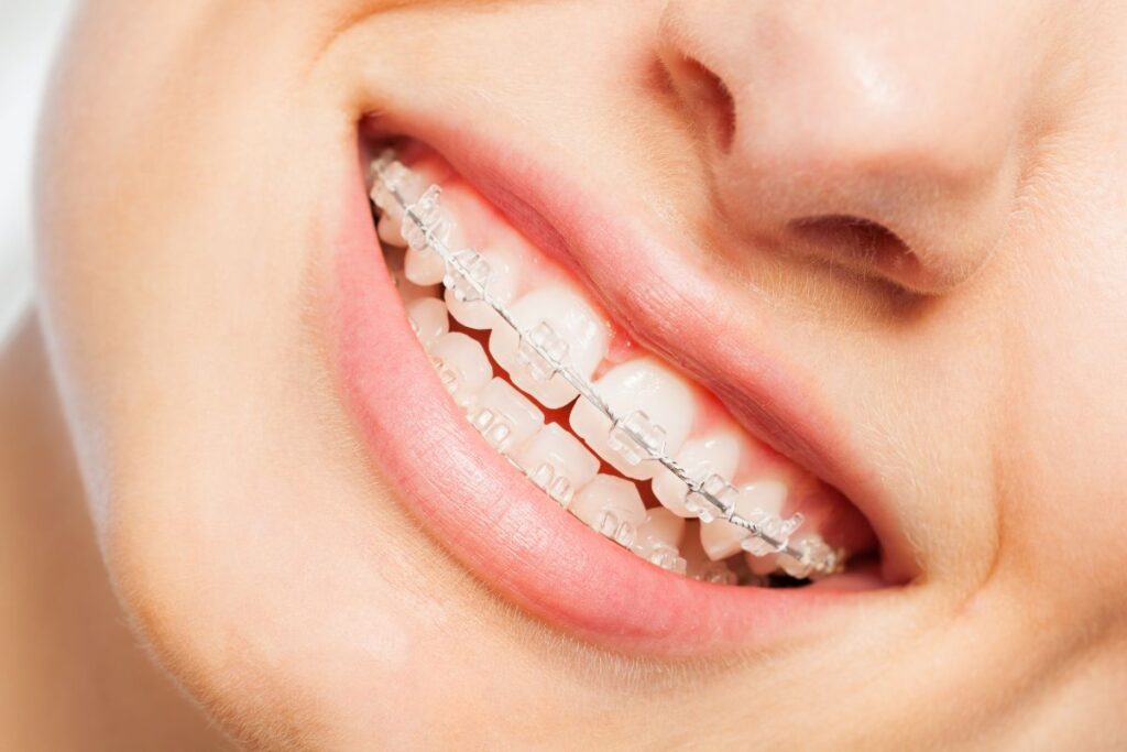 Clear Braces - Different types of clear braces