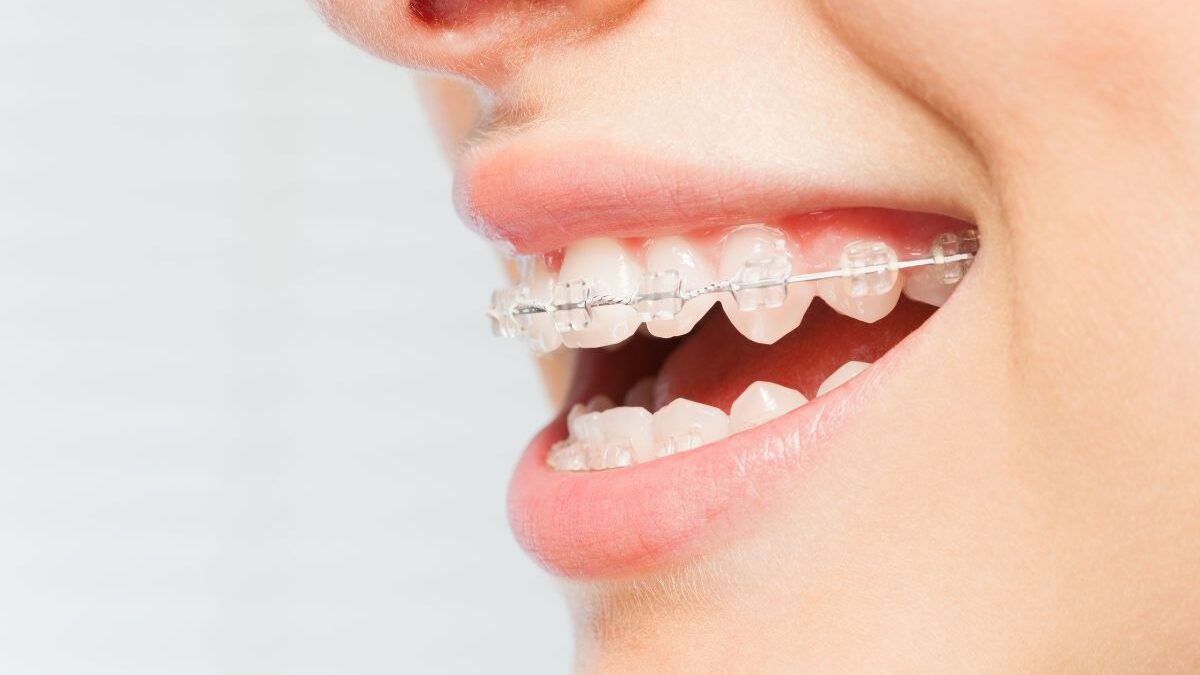 Clear Braces: A Comprehensive Guide to Your Best Smile