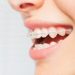 Clear Braces Types, Benefits & How To Clean 5 Clear Braces: A Comprehensive Guide to Your Best Smile