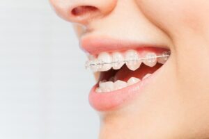Clear Braces: A Comprehensive Guide to Your Best Smile
