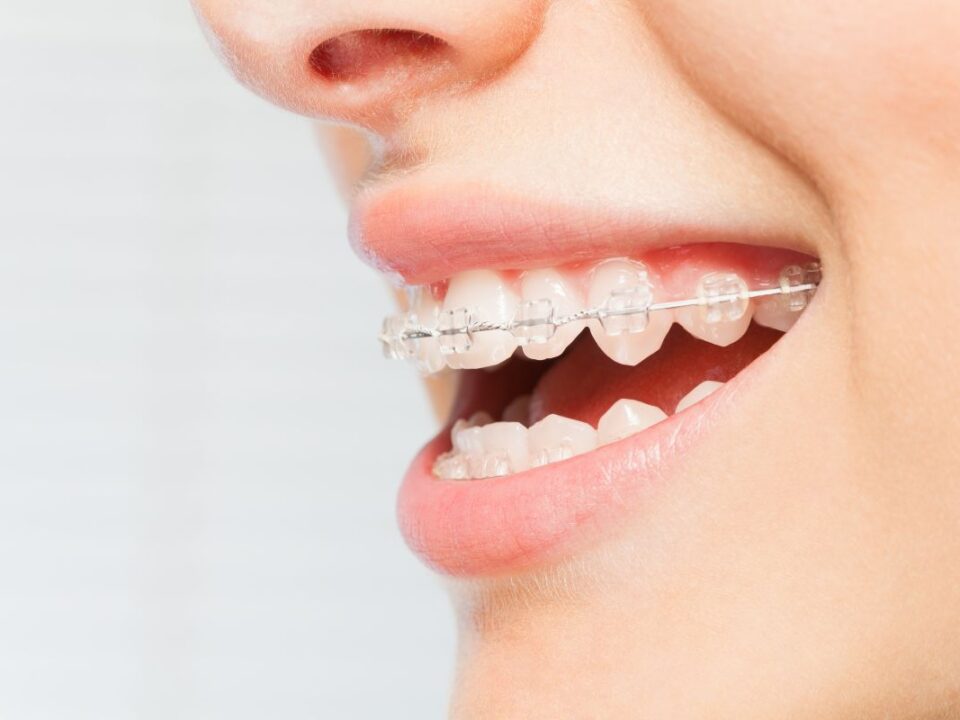 Clear Braces: A Comprehensive Guide to Your Best Smile