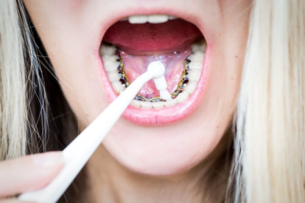 lingual braces - Cleaning Issues