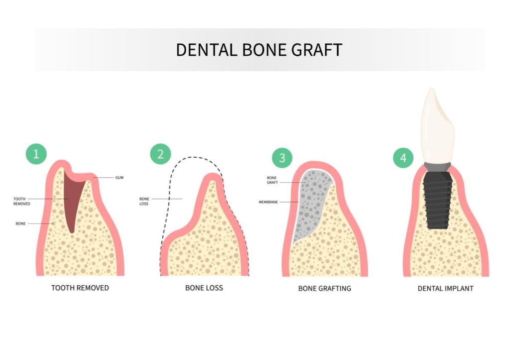 dental implant procedure - dental bone grafting