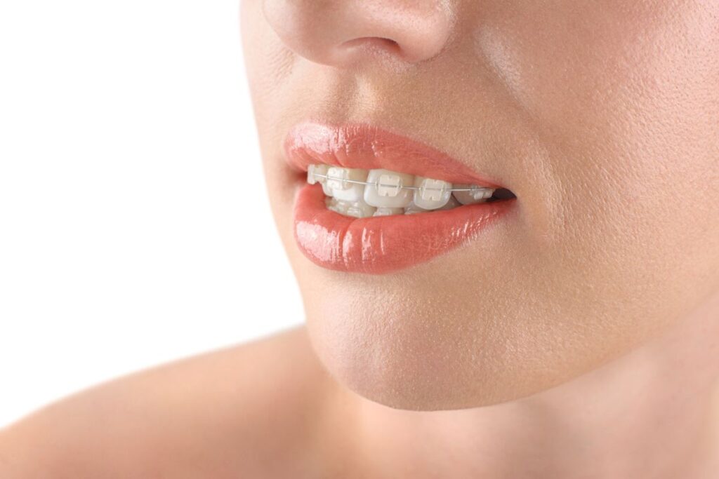 Clear Braces - What Exactly Are Clear Braces?