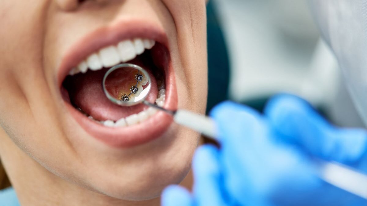 Alternatives to Lingual braces