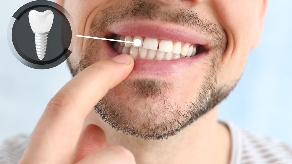 Dental implant procedure