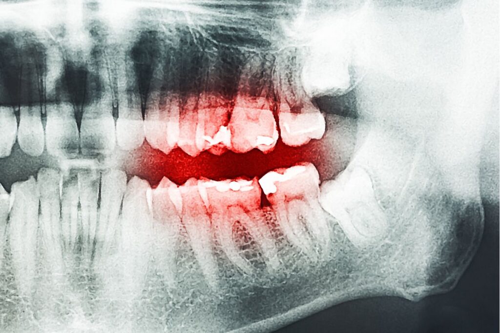 what is cavity between teeth - prevention