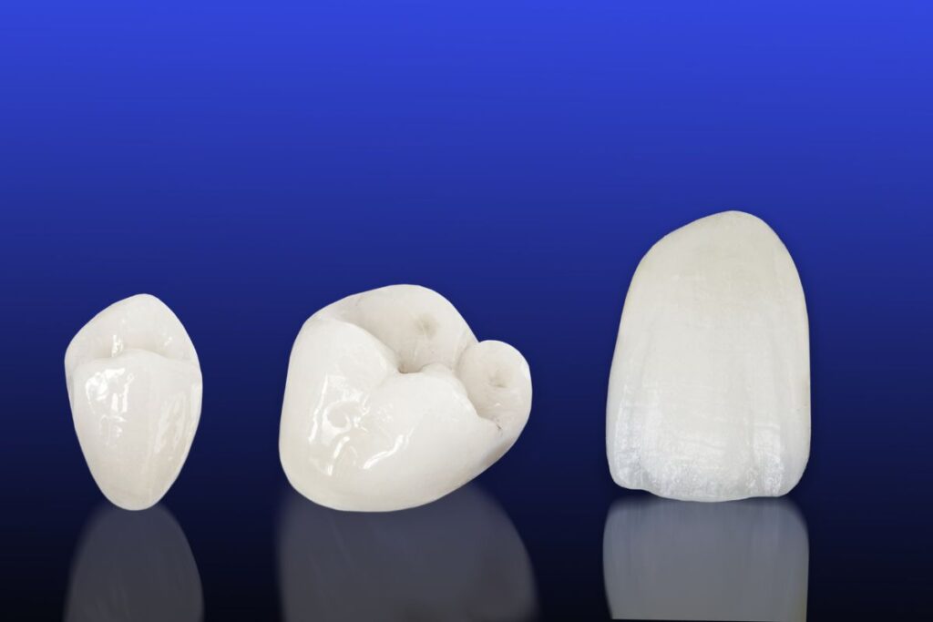 what is cavity between teeth - dental crowns