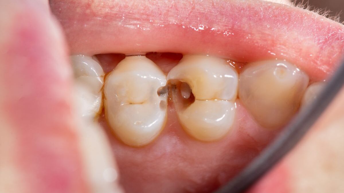 Cavity between teeth; How is it even possible?