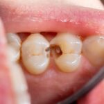 Cavity between teeth; How is it even possible?