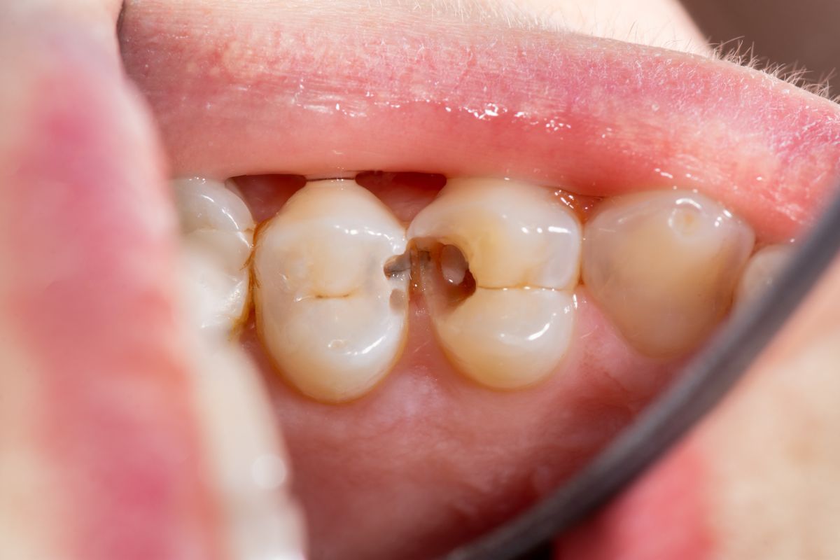 Cavity between teeth; How is it even possible?