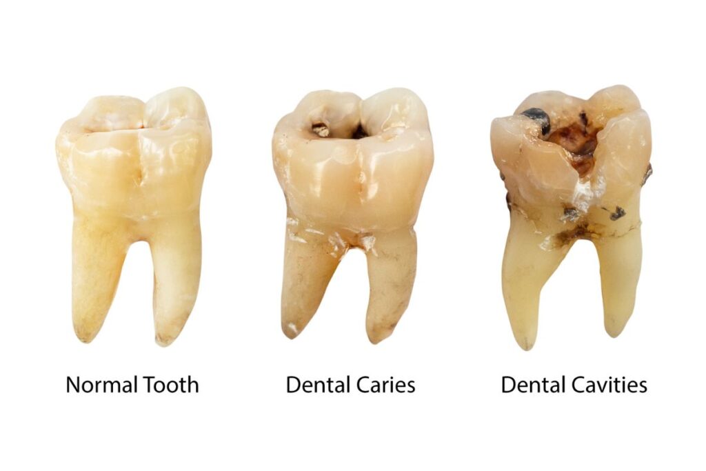 what is a cavity - healthy tooth vs cavity