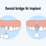 Dental Bridge vs. Implant