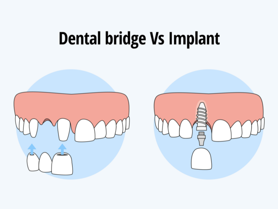 Dental Bridge vs. Implant