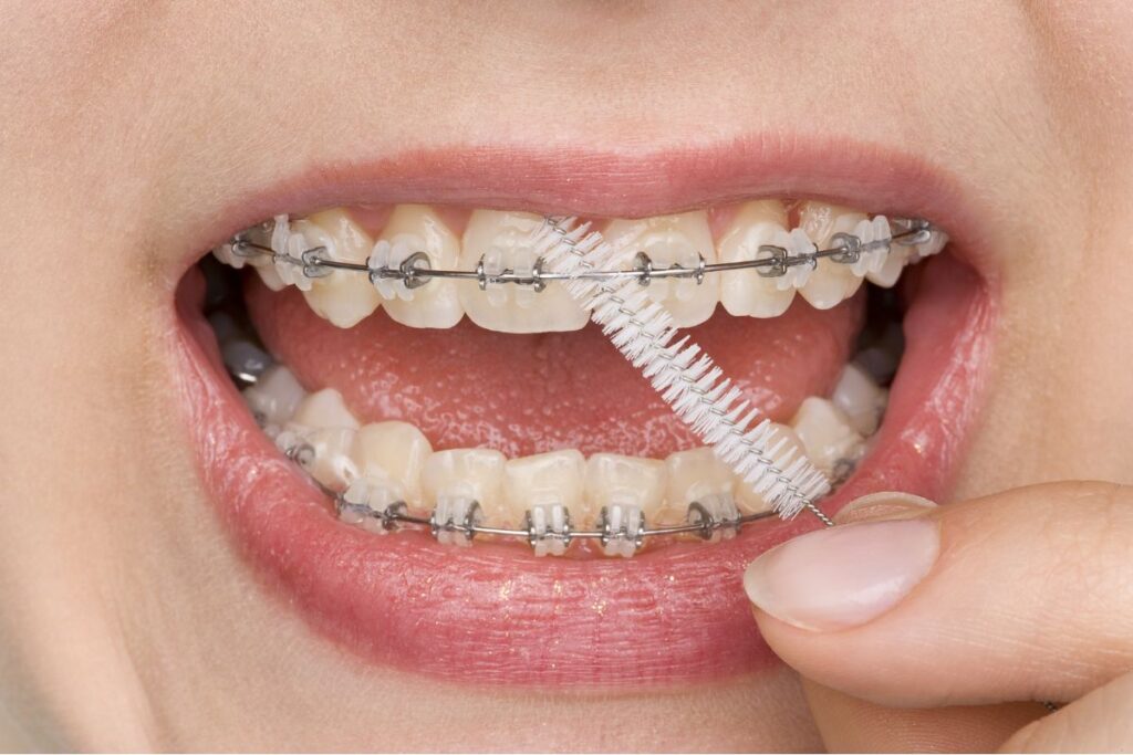 Tips and Tricks for Easier Flossing with Braces
