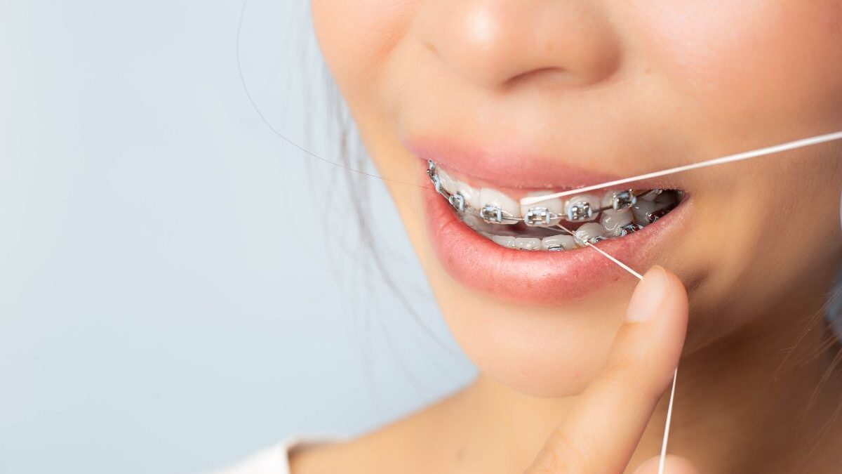 Flossing 101: How To Floss With Braces
