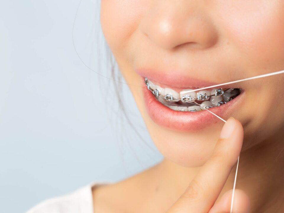 Flossing 101: How To Floss With Braces