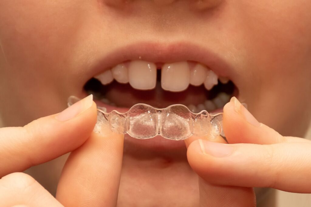 Invisalign® for kids - Caring for Kids with Invisalign® Aligners