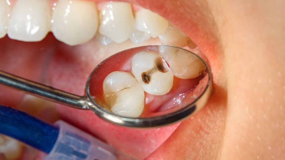 What Is a Cavity: Unraveling the Enigma