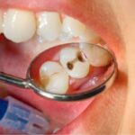 What Is a Cavity: Unraveling the Enigma