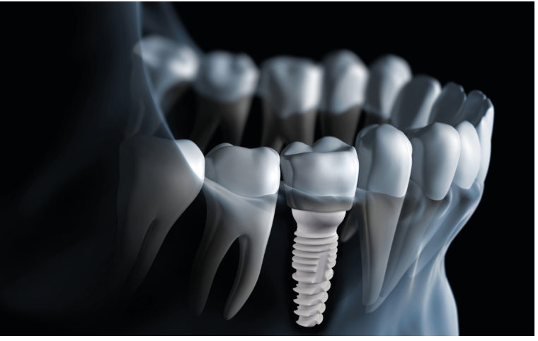 Dental Bridge vs. Implant - pros and cons of dental implants