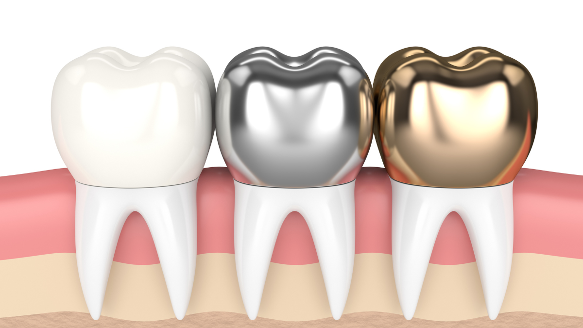 Types of Dental Crowns