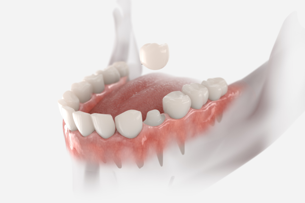 Procedure of Dental Crowns
