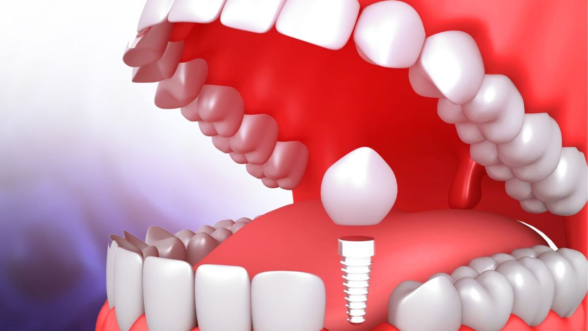 Same Day Dental Implants