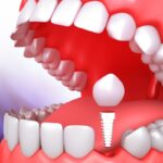 Same Day Dental Implants