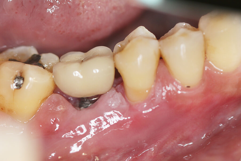 What Are The Signs of Dental Implant Infection?