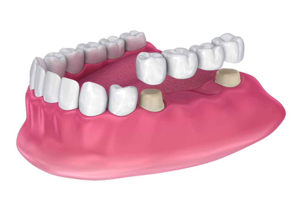 Dental Bridge Infection Symptoms - what is a dental bridge?