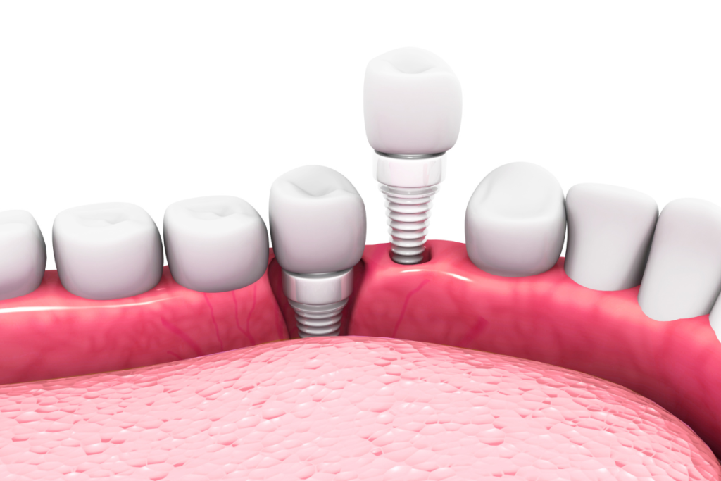 Dental Implant Types - Zirconia dental implant