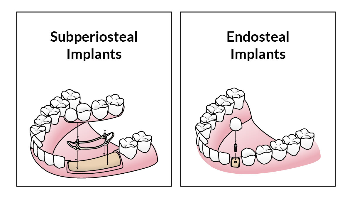 What Are The Different Types of Dental Implants?