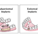 What Are The Different Types of Dental Implants?