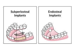 Dental Implant Types, How Many Are There?