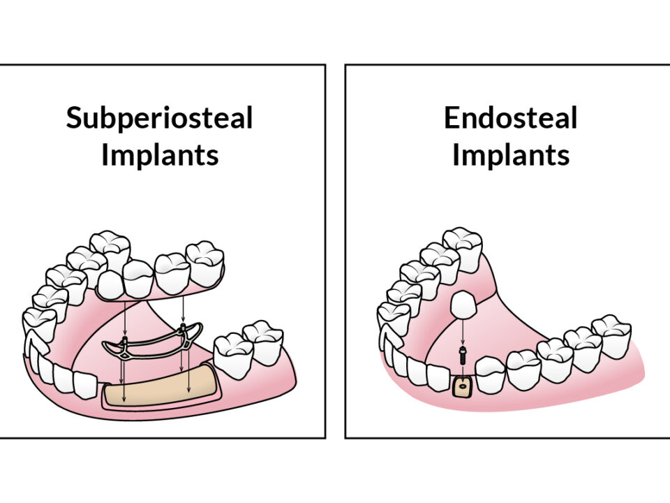 Dental Implant Types, How Many Are There?