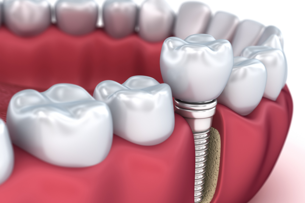 Dental Implant Types - Titanium dental implant