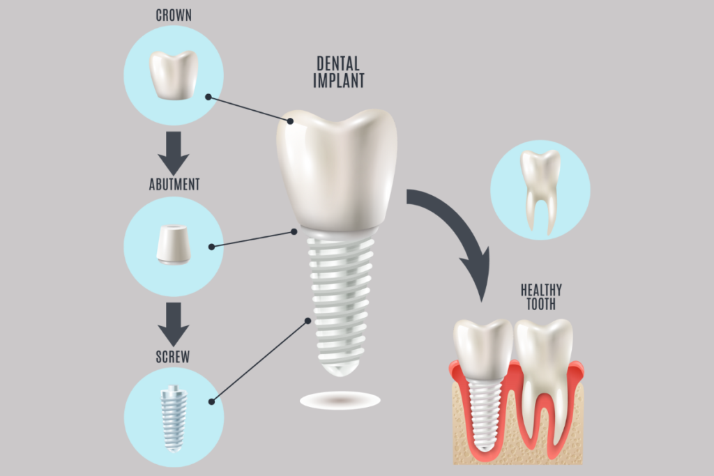 Dental Implant Types - what is a dental implant?