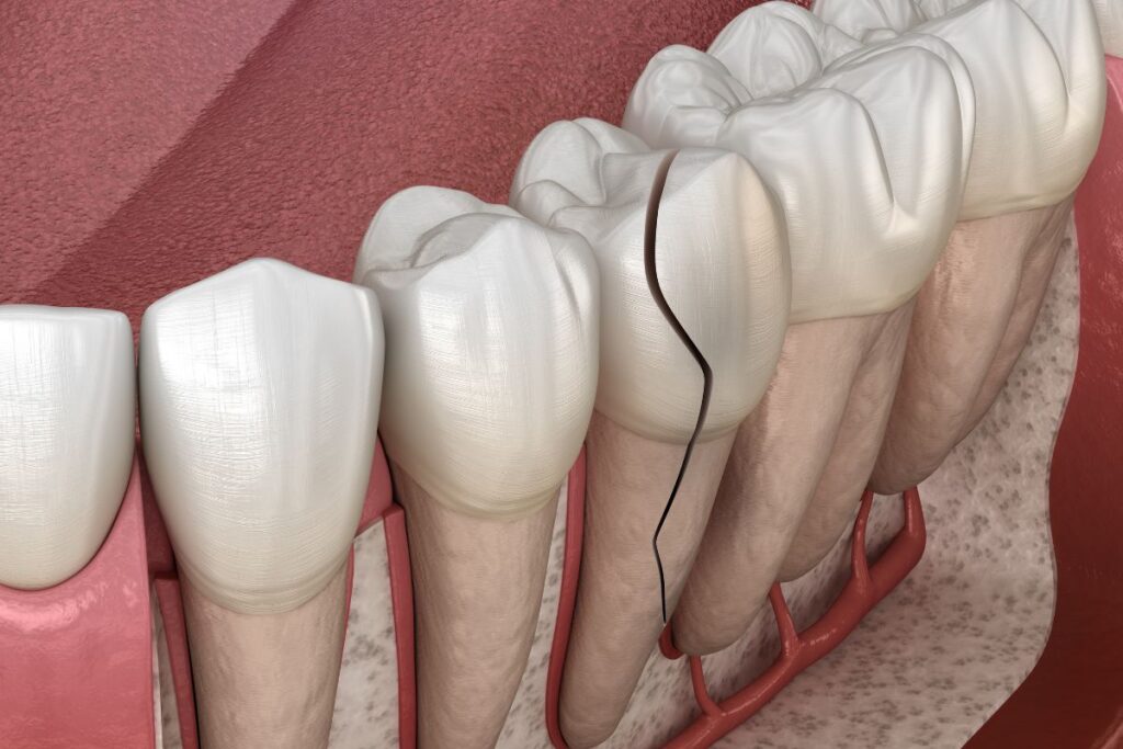 Root Canal Risks - cracked teeth