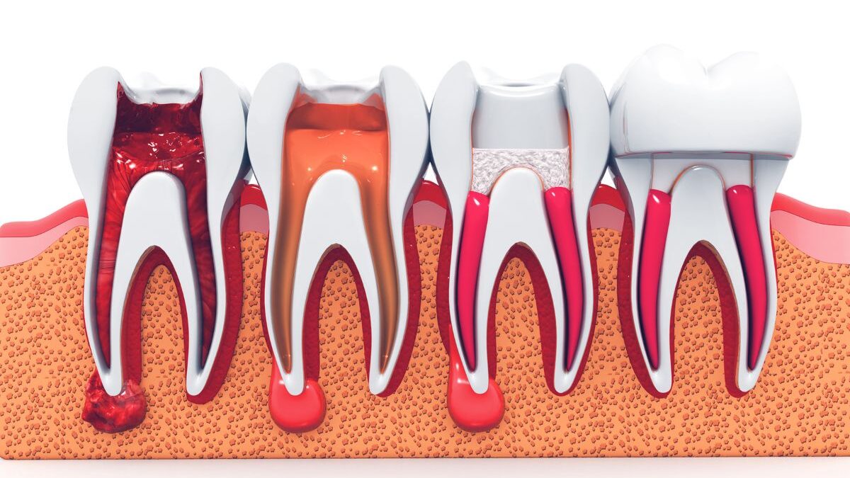 Root Canal Risks, What No One Told You