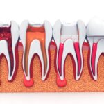 Root Canal Risks, What No One Told You 4 Root Canal Risks, What No One Told You