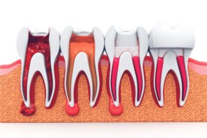 Root Canal Risks, What No One Told You