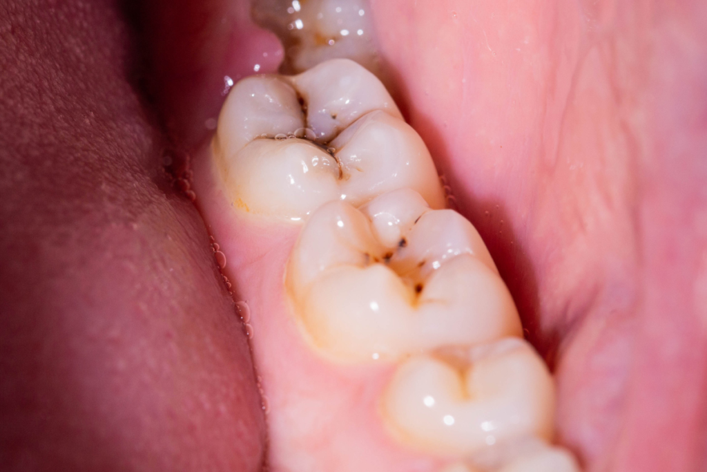Sudden Tooth Pain - cavity