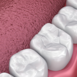 Mercury Free Dentistry