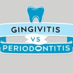 Gingivitis vs Periodontitis